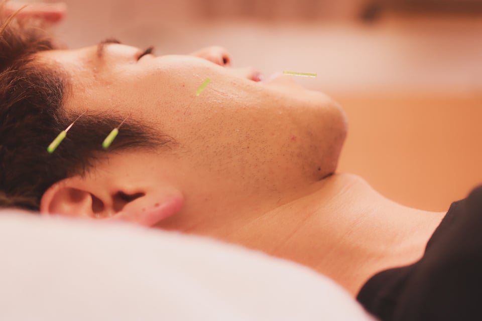 Cosmetic acupuncture in Asia