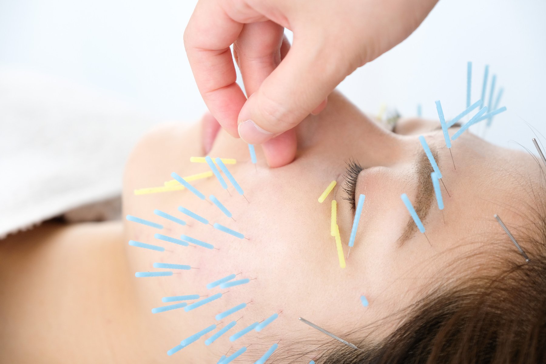 Up of a woman getting acupuncture on her face at an acupuncture clinic