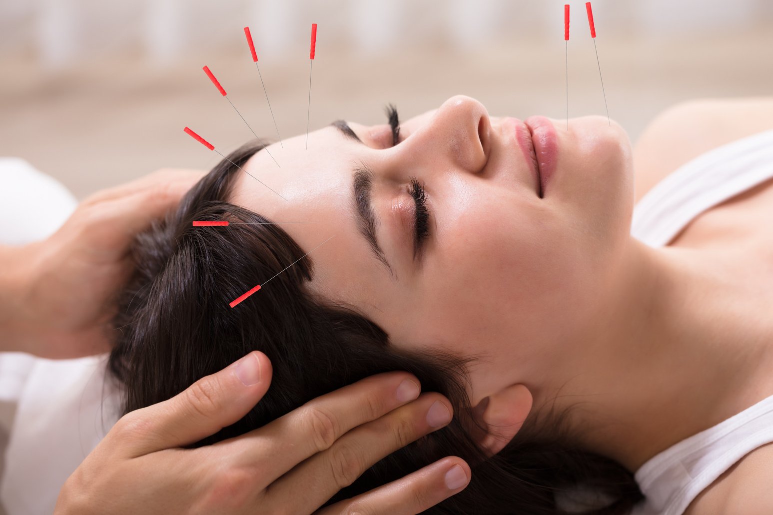 Woman Receiving Acupuncture Treatment